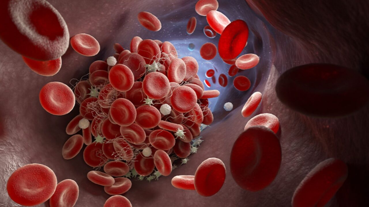 Trombosis de la vena porta: una condición muy difícil
